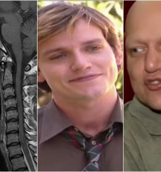 Este era o cancer que ator Edward Boggiss enfrentava antes