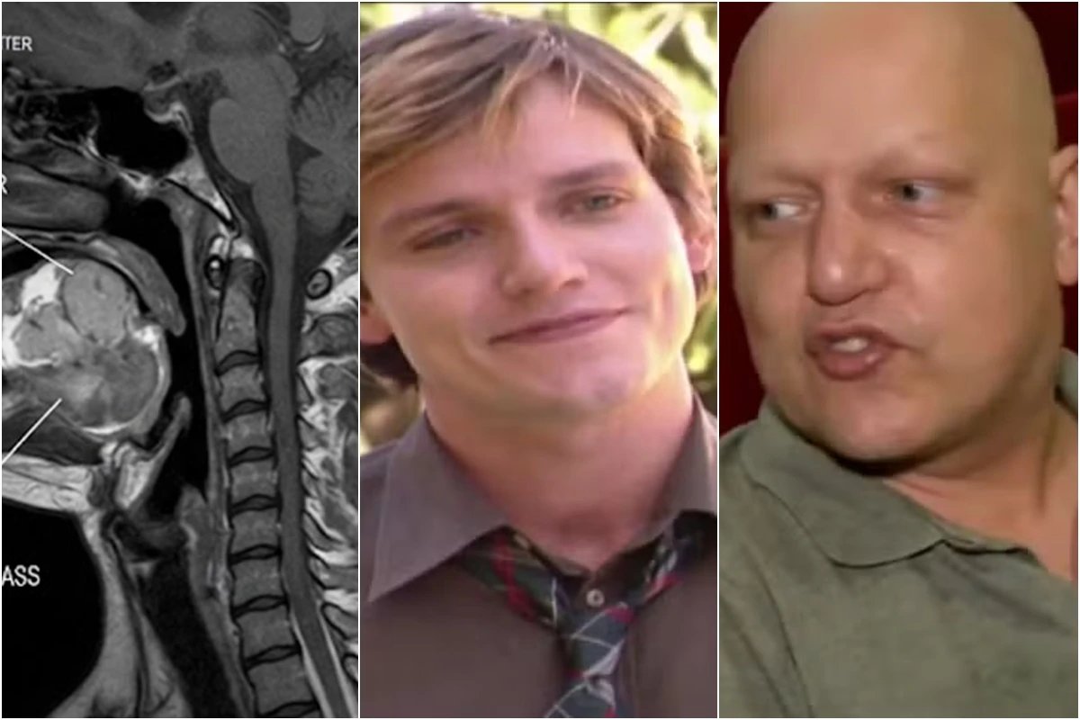 Este era o cancer que ator Edward Boggiss enfrentava antes
