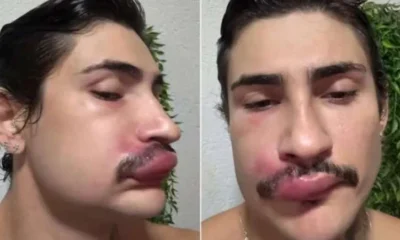 Famoso e hospitalizado as pressas apos espremer espinha no.webp