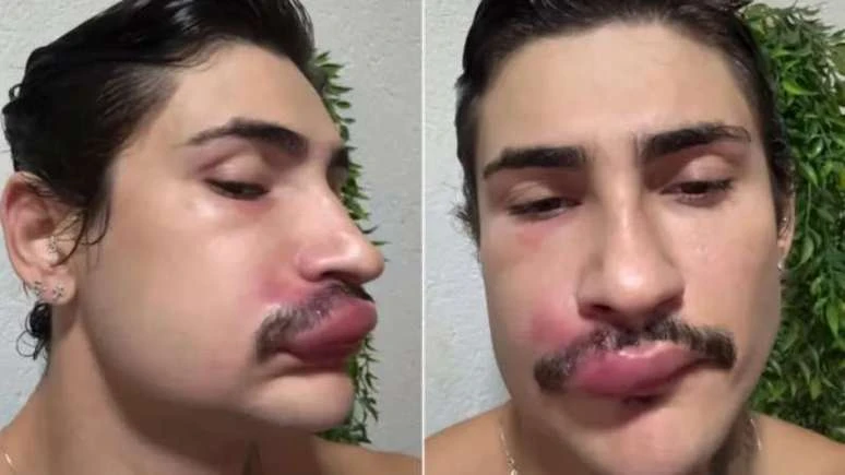 Famoso e hospitalizado as pressas apos espremer espinha no.webp
