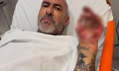 Henrique Fogaca expoe feridas de acidente e revela roubo de
