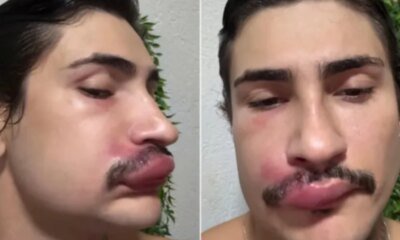 Influenciador espreme espinha e vai parar no hospital ‘Risco de