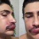 Influenciador espreme espinha e vai parar no hospital ‘Risco de