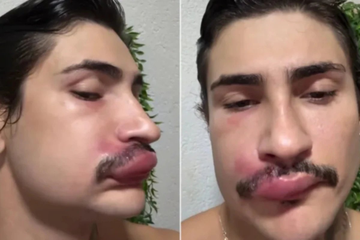 Influenciador espreme espinha e vai parar no hospital ‘Risco de
