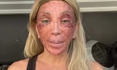 Maya Massafera explica aparencia com rosto machucado apos procedimento video