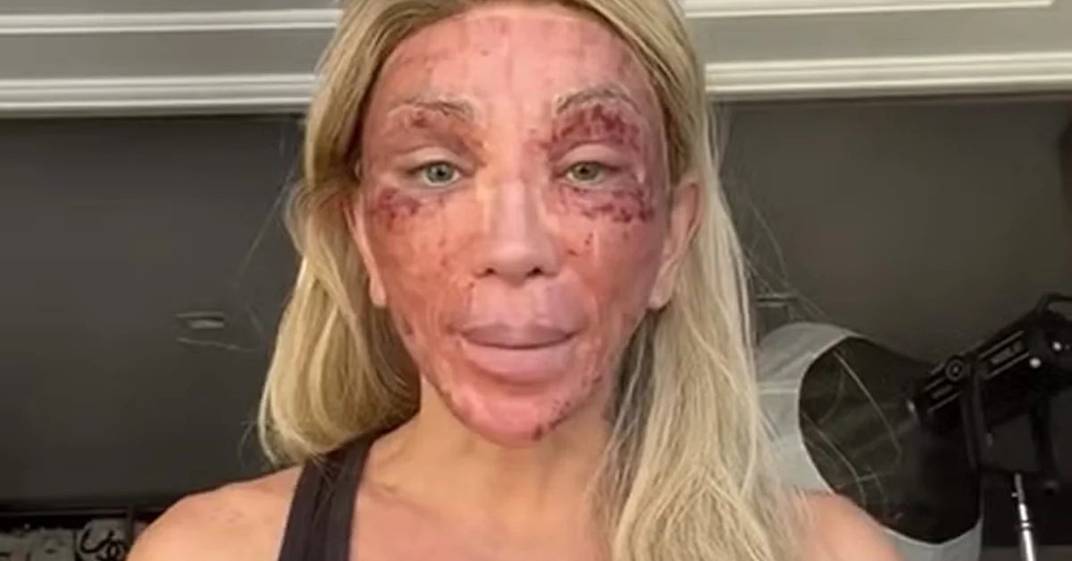 Maya Massafera explica aparencia com rosto machucado apos procedimento video