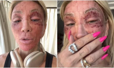 Maya Massafera mostra estado do rosto apos procedimento Nao.webp
