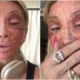 Maya Massafera mostra estado do rosto apos procedimento Nao.webp