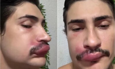 Por causa de uma espinha influenciador e internado e medicos