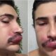 Por causa de uma espinha influenciador e internado e medicos