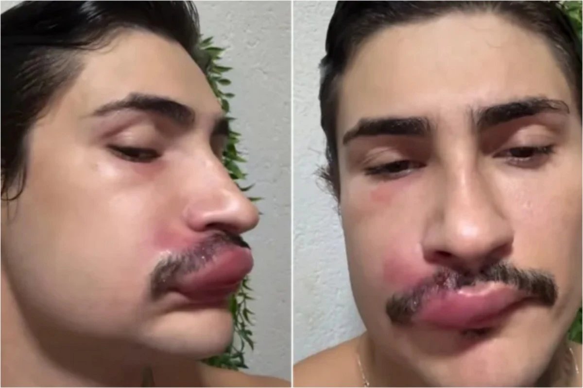 Por causa de uma espinha influenciador e internado e medicos