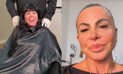 Antes de comecar transplante capilar Gretchen raspa cabeca em.webp