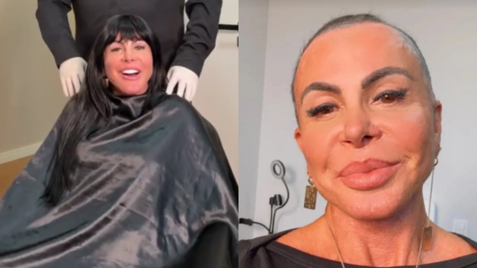 Antes de comecar transplante capilar Gretchen raspa cabeca em.webp