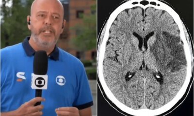 Doenca autoimune comprometimento de nervos e tumor Alex Escobar passa