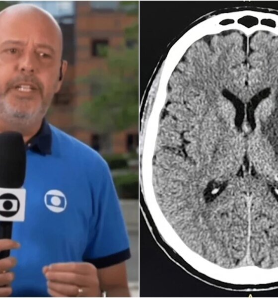 Doenca autoimune comprometimento de nervos e tumor Alex Escobar passa