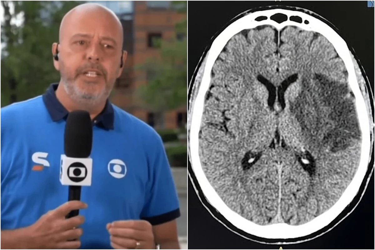 Doenca autoimune comprometimento de nervos e tumor Alex Escobar passa