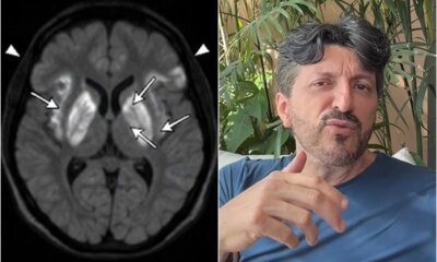 Esta e a doenca rara sem cura e que causa