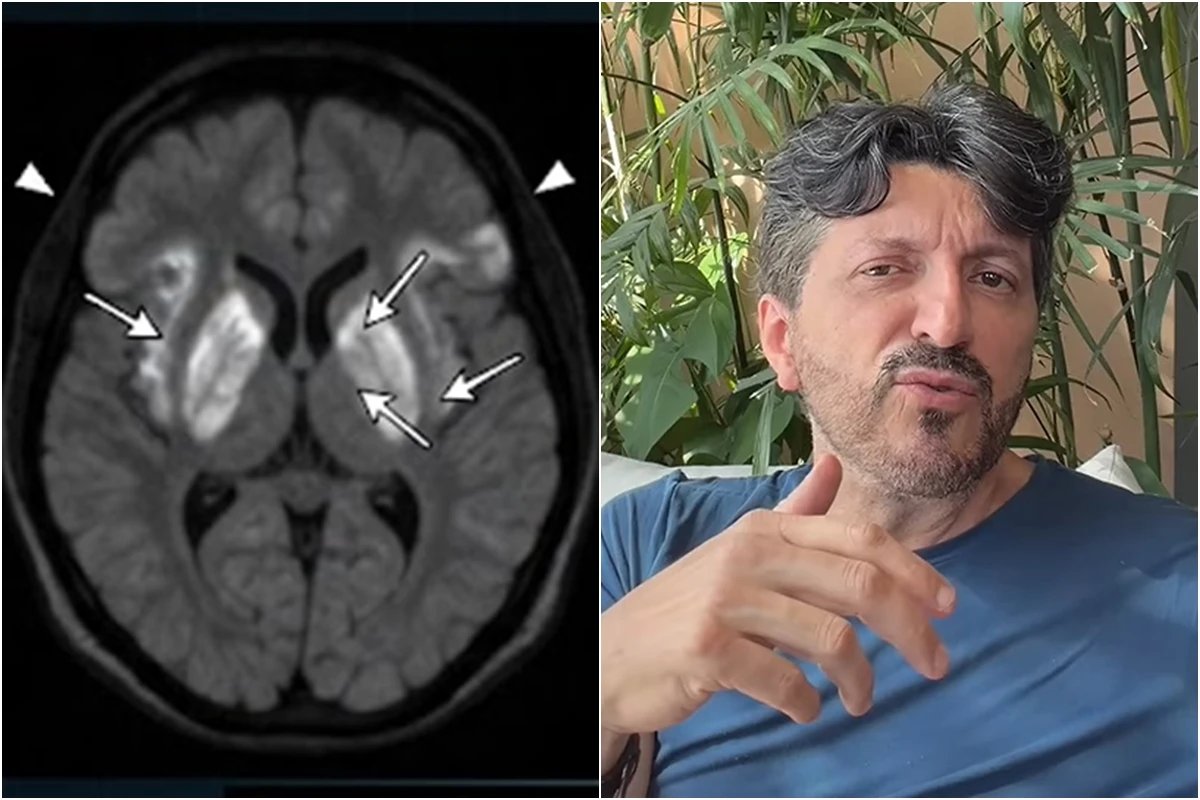 Esta e a doenca rara sem cura e que causa