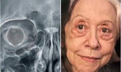 Este e o problema de saude diagnosticado em Fernanda Montenegro