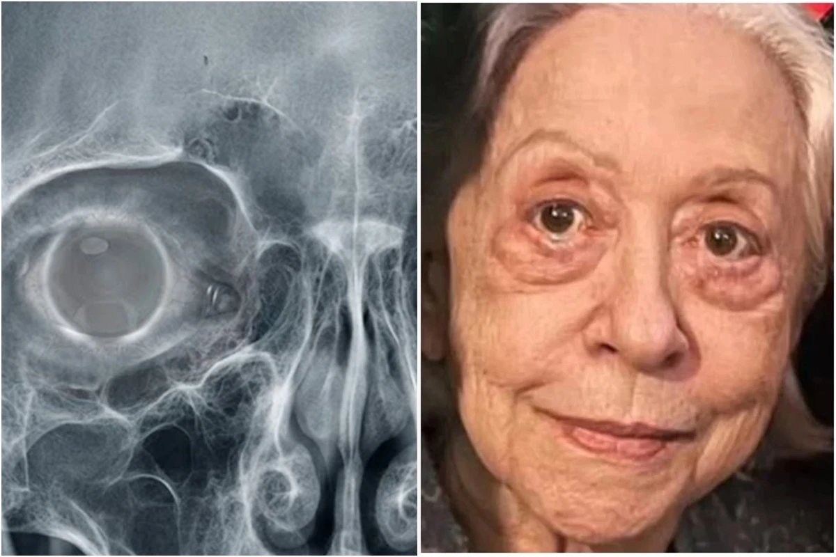 Este e o problema de saude diagnosticado em Fernanda Montenegro