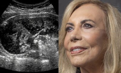Este foi o diagnostico que Arlete Salles recebeu aos 88
