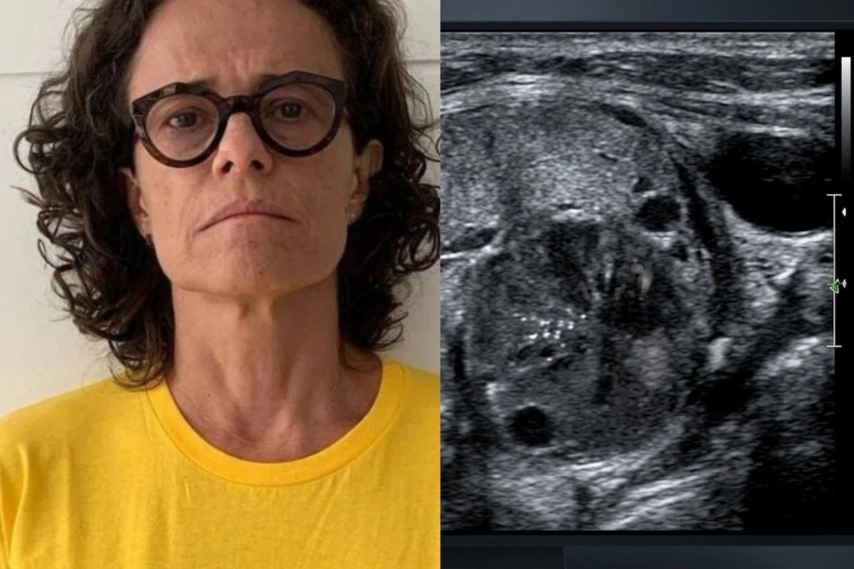Este foi o tipo de cancer diagnosticado na cantora Zelia