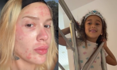 Karoline Lima mostra rosto apos procedimento e filha pede maquiagem