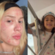 Karoline Lima mostra rosto apos procedimento e filha pede maquiagem