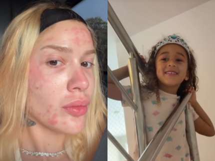 Karoline Lima mostra rosto apos procedimento e filha pede maquiagem