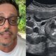 Lucio Mauro Filho conta como descobriu cancer e faz alerta
