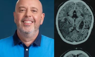 Miastenia gravis Globo divulga diagnostico de Alex Escobar doenca afeta
