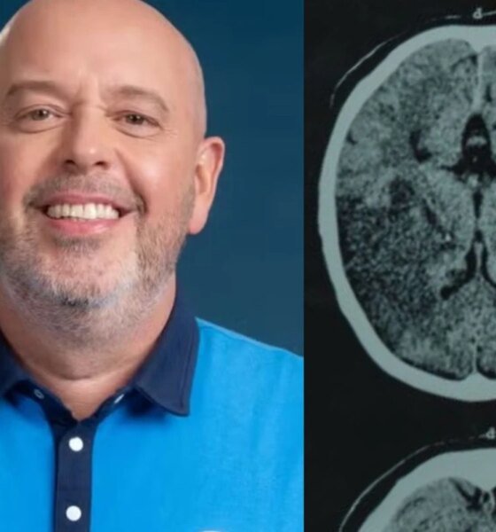 Miastenia gravis Globo divulga diagnostico de Alex Escobar doenca afeta