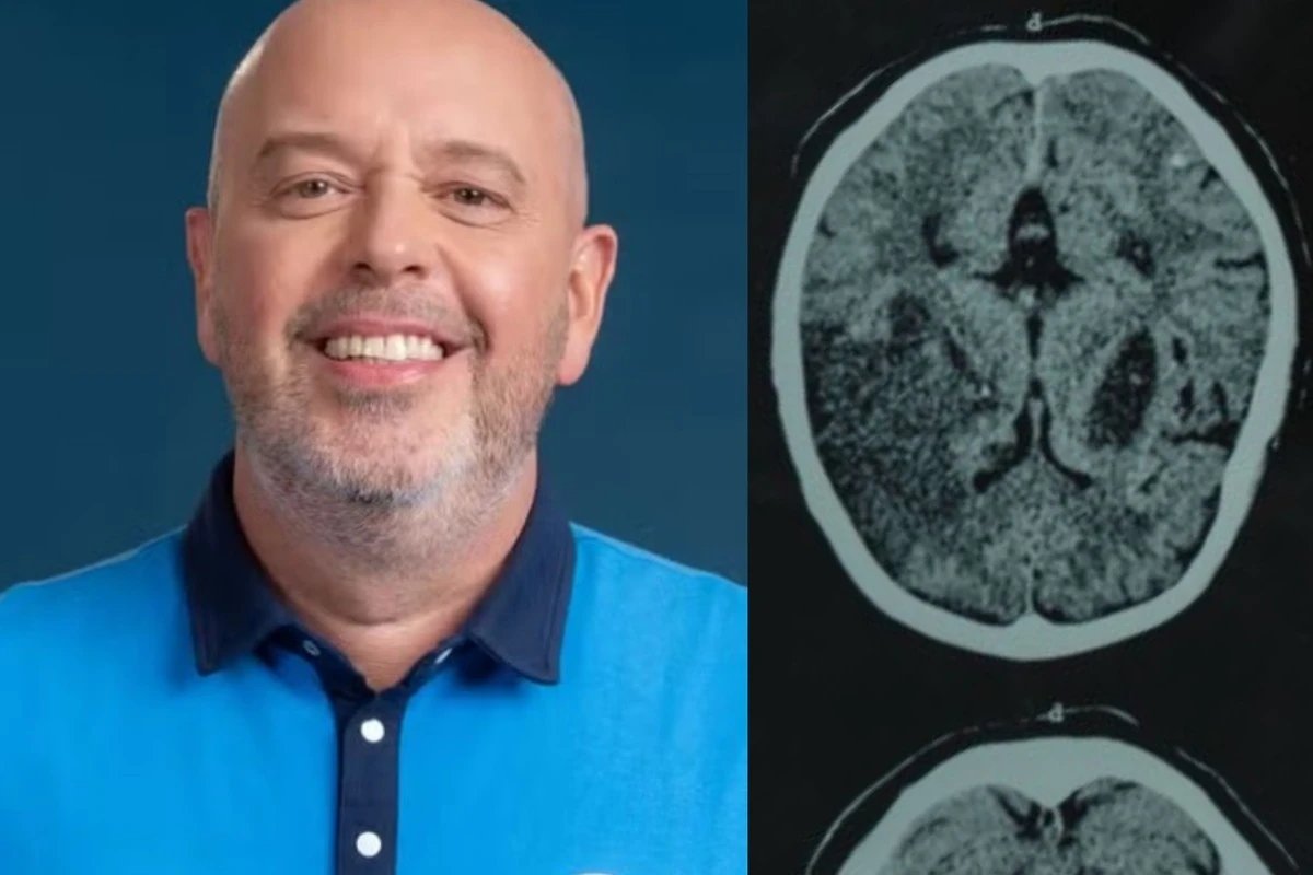 Miastenia gravis Globo divulga diagnostico de Alex Escobar doenca afeta