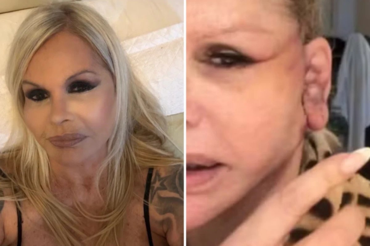 Monique Evans detalha cuidados diarios da esposa apos cirurgia plastica