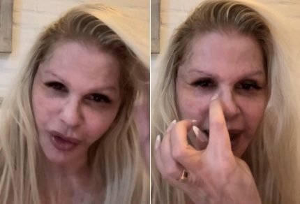 Monique Evans mostra rosto sete dias apos cirurgia plastica Estou