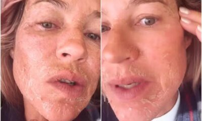 O que aconteceu Luana Piovani aparece com rosto descascando e