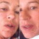 O que aconteceu Luana Piovani aparece com rosto descascando e