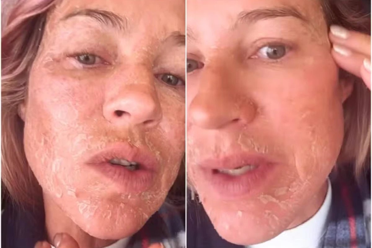 O que aconteceu Luana Piovani aparece com rosto descascando e