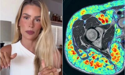 Corpo de Yasmin Brunet sofre com sintomas preocupantes de doenca