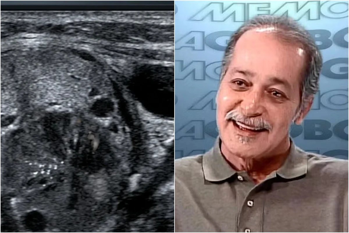 Esta foi a causa da morte do ator Gracindo Jr