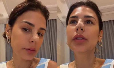 Simone Mendes aparece com curativos apos procedimento estetico veja.webp