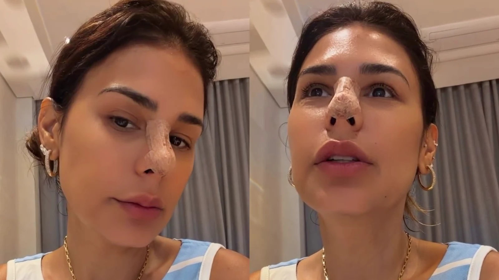 Simone Mendes aparece com curativos apos procedimento estetico veja.webp